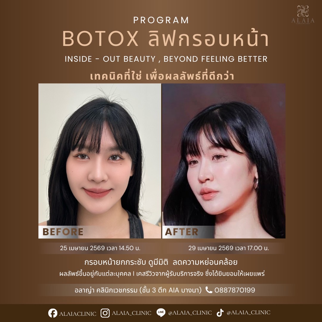 Botox Real Result 2